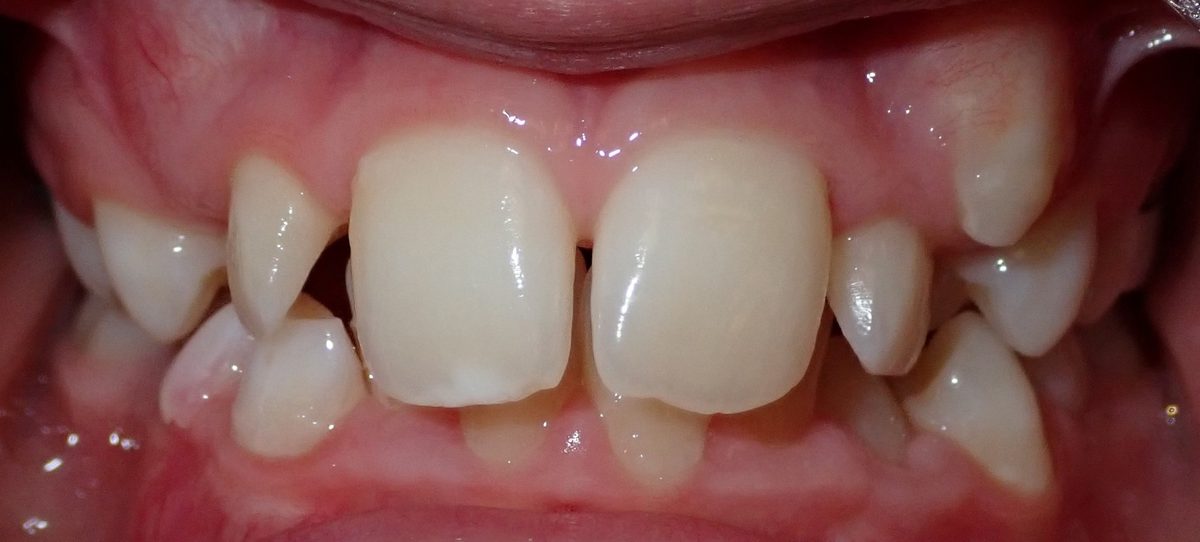 Vivid Smiles patient case 14 before and after treatment comparison before